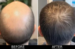 Before & After Hair Transplant: Real Results and Complete Guide by Nilam Hair Transplant Ranchi